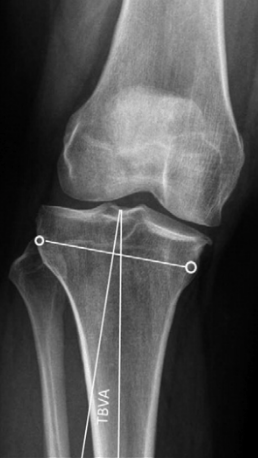 osteocondroza genunchiului 3 grade)